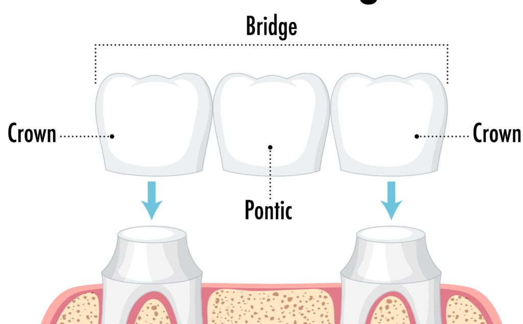 dental bridge