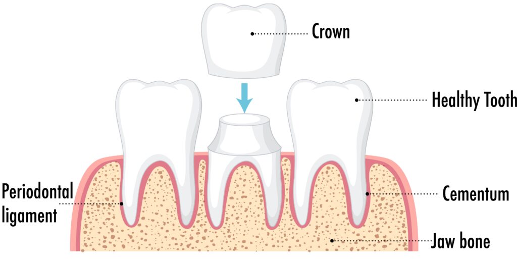 dental crown